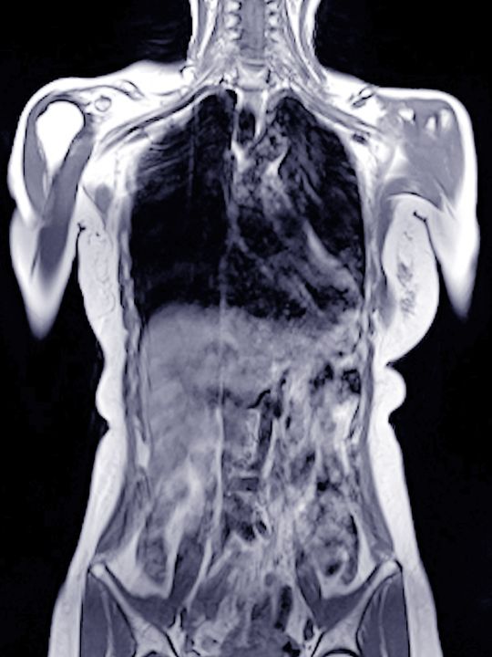 MR abdomena