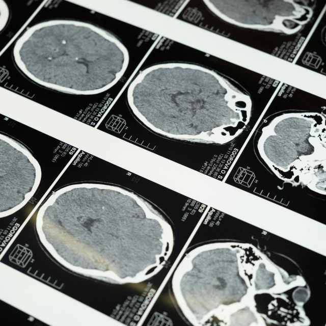 Neurologija - snimci mozga