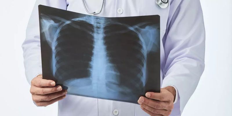 Rendgen pluća COVID-19