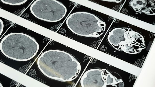 Neurologija Neurologija