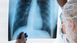 Uzroci i simptomi malignog tumora pluća