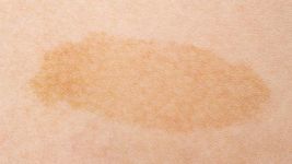 Uzroci, simptomi i lečenje tumora kože