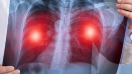 Plućna fibroza: Vodič kroz simptome, prevenciju i podršku