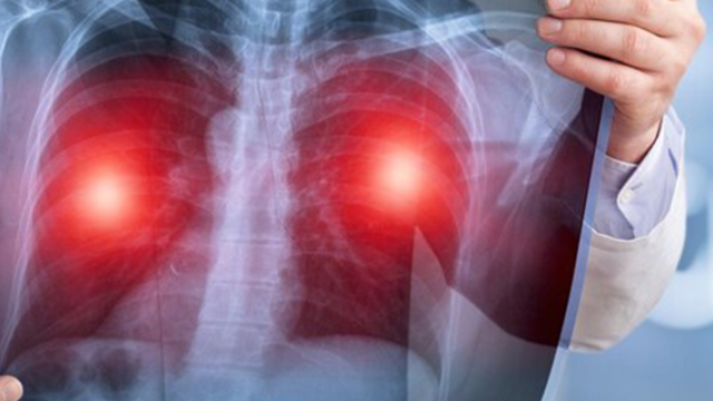 Plućna fibroza: Vodič kroz simptome, prevenciju i podršku Plućna fibroza: Vodič kroz simptome, prevenciju i podršku