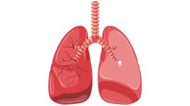 Pneumotoraks: uzroci, simptomi i lečenje