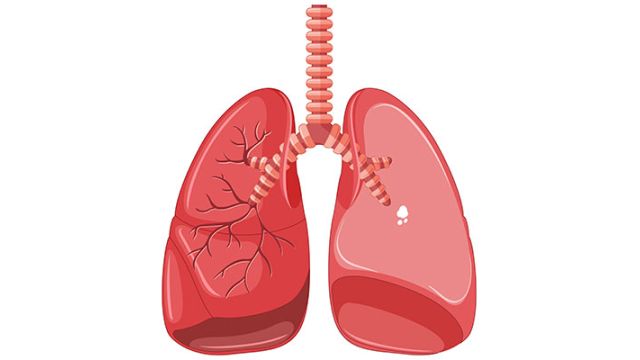 Pneumotoraks: uzroci, simptomi i lečenje Pneumotoraks: uzroci, simptomi i lečenje