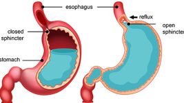 Ahalazija jednjaka: vodič za dijagnozu i terapiju