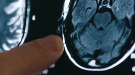 Ishemija mozga: Simptomi i dijagnostika