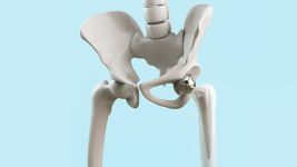 Prelom kuka: Uzroci, simptomi i lečenje