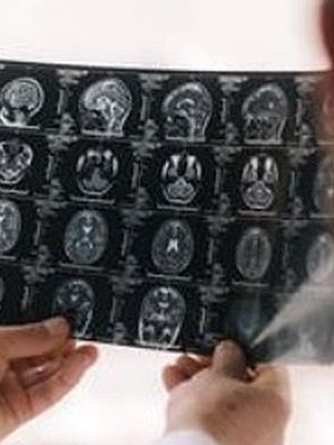 Magnetna rezonanca glave