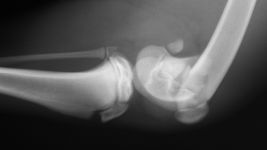 Prelom butne kosti: Simptomi, dijagnoza i oporavak